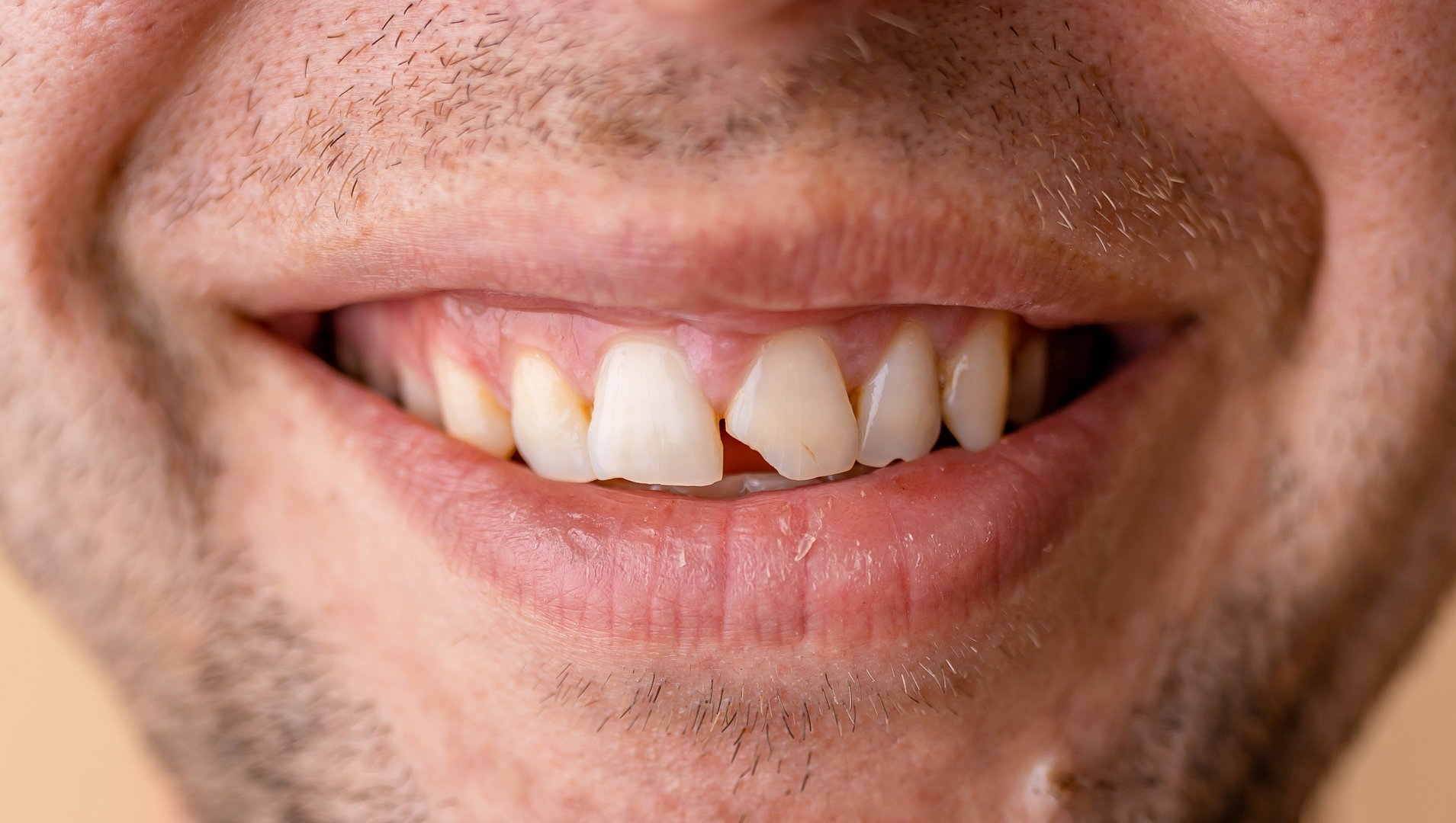 Broken Tooth Treatment