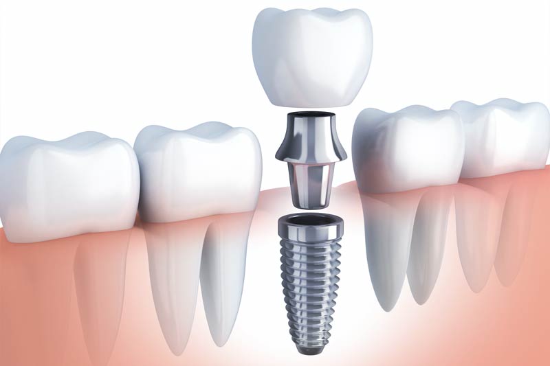 Implants Dentist in Sarasota