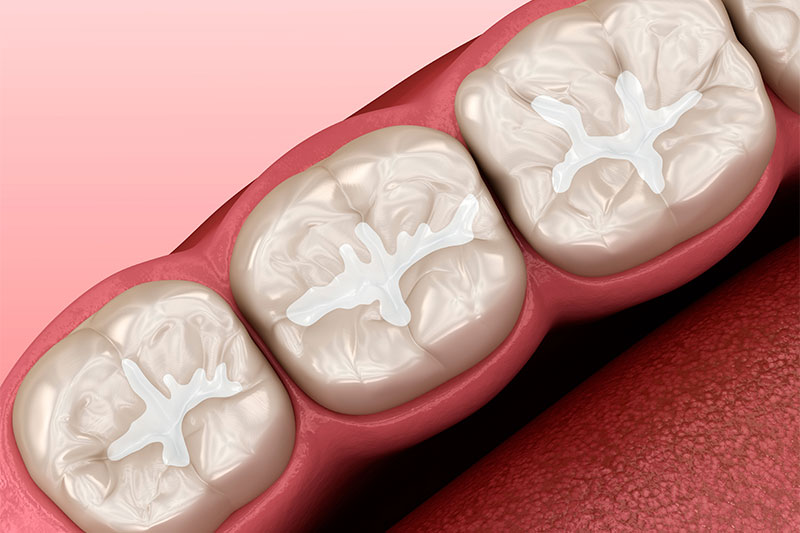 Dental Sealants in Sarasota